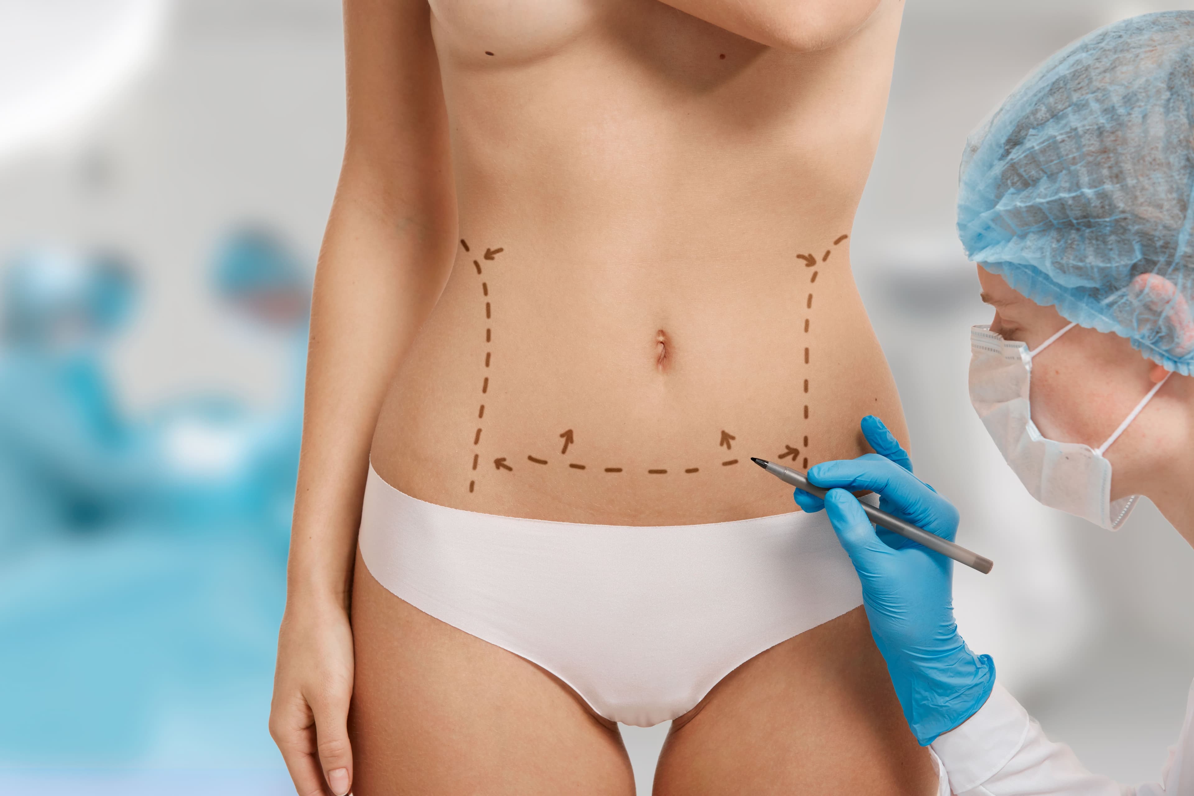 Abdominoplasty
