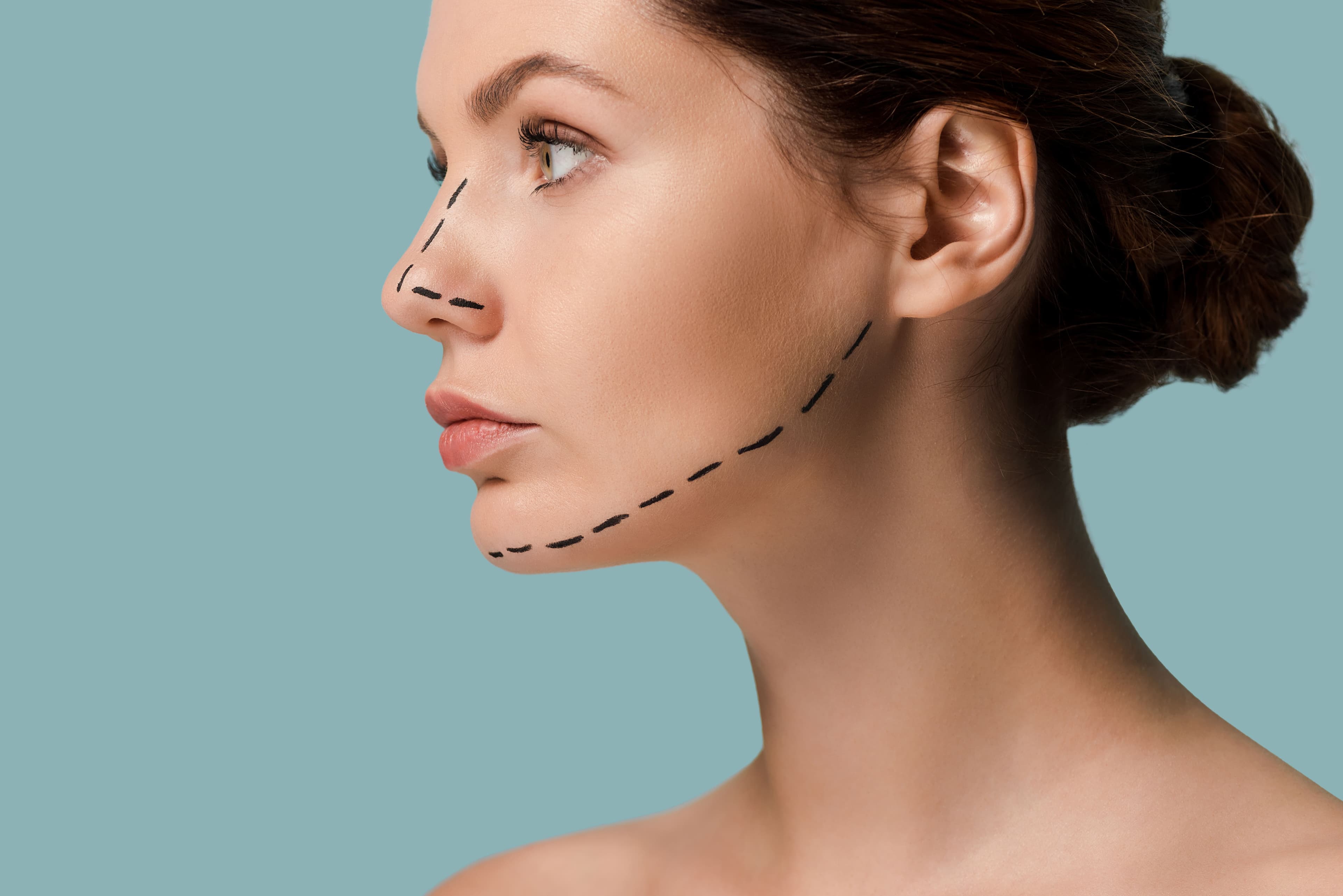 Rhinoplasty
